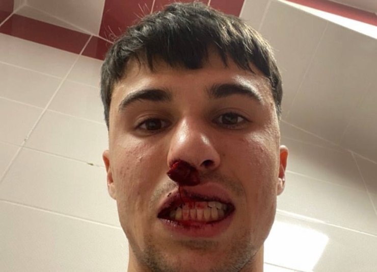Alessandro Bianco è stato ferito da un tifoso nel finale di Sivasspor-Fiorentina