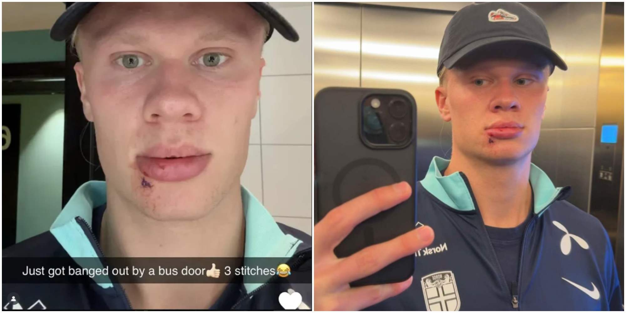 Erling Haaland infortunio al volto